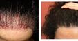 Bisanga Hair Restoration