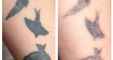 The Missing Ink: Laser Tattoo Removal