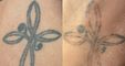 PHÚ TÔN - Laser Tattoo Removal