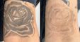 PHU TON - Laser Tattoo Removal