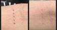 PHU TON - Laser Tattoo Removal