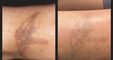PHU TON - Laser Tattoo Removal