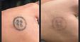 PHU TON - Laser Tattoo Removal