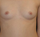  Bandingkan Sebelum & Sesudah Foto Augmentasi Payudara