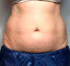 Bandingkan Sebelum & Sesudah Foto CoolSculpting