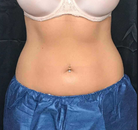 Bandingkan Sebelum & Sesudah Foto CoolSculpting