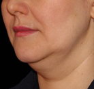 Bandingkan Sebelum & Sesudah Foto CoolSculpting