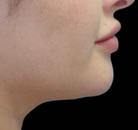 Bandingkan Sebelum & Sesudah Foto CoolSculpting