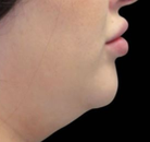 Bandingkan Sebelum & Sesudah Foto CoolSculpting