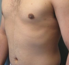 Bandingkan Sebelum & Sesudah Foto CoolSculpting