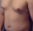 Bandingkan Sebelum & Sesudah Foto CoolSculpting