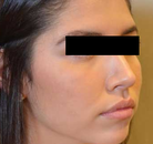  Bandingkan Sebelum & Sesudah Foto Rinoplasti