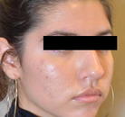  Bandingkan Sebelum & Sesudah Foto Rinoplasti