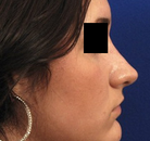  Bandingkan Sebelum & Sesudah Foto Rinoplasti