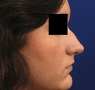  Bandingkan Sebelum & Sesudah Foto Rinoplasti