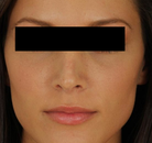  Bandingkan Sebelum & Sesudah Foto Rinoplasti