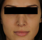  Bandingkan Sebelum & Sesudah Foto Rinoplasti