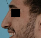  Bandingkan Sebelum & Sesudah Foto Rinoplasti