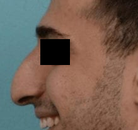  Bandingkan Sebelum & Sesudah Foto Rinoplasti