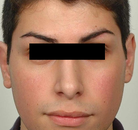  Bandingkan Sebelum & Sesudah Foto Rinoplasti