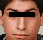  Bandingkan Sebelum & Sesudah Foto Rinoplasti