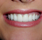 So sánh Ảnh Trước và Sau của Dán sứ Veneers