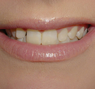 So sánh Ảnh Trước và Sau của Dán sứ Veneers