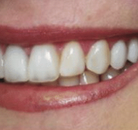 So sánh Ảnh Trước và Sau của Dán sứ Veneers