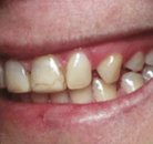 So sánh Ảnh Trước và Sau của Dán sứ Veneers