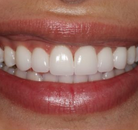 So sánh Ảnh Trước và Sau của Dán sứ Veneers