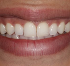 So sánh Ảnh Trước và Sau của Dán sứ Veneers