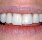 So sánh Ảnh Trước và Sau của Dán sứ Veneers