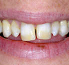 So sánh Ảnh Trước và Sau của Dán sứ Veneers