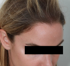 Bandingkan Sebelum & Sesudah Foto Transplantasi Rambut