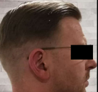 Bandingkan Sebelum & Sesudah Foto Transplantasi Rambut