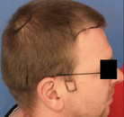 Bandingkan Sebelum & Sesudah Foto Transplantasi Rambut