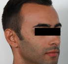 Bandingkan Sebelum & Sesudah Foto Transplantasi Rambut