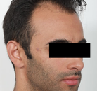 Bandingkan Sebelum & Sesudah Foto Transplantasi Rambut