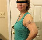 Bandingkan Sebelum & Sesudah Foto Gastric Sleeve