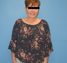 Bandingkan Sebelum & Sesudah Foto Gastric Sleeve