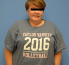 Bandingkan Sebelum & Sesudah Foto Gastric Sleeve