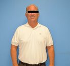 Bandingkan Sebelum & Sesudah Foto Gastric Sleeve