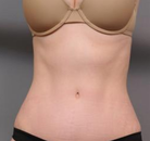  Bandingkan Sebelum & Sesudah Foto Tummy Tuck