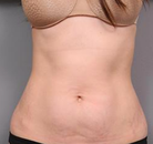  Bandingkan Sebelum & Sesudah Foto Tummy Tuck
