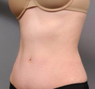  Bandingkan Sebelum & Sesudah Foto Tummy Tuck