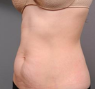  Bandingkan Sebelum & Sesudah Foto Tummy Tuck