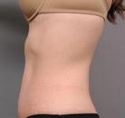  Bandingkan Sebelum & Sesudah Foto Tummy Tuck