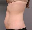  Bandingkan Sebelum & Sesudah Foto Tummy Tuck