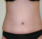  Bandingkan Sebelum & Sesudah Foto Tummy Tuck