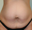  Bandingkan Sebelum & Sesudah Foto Tummy Tuck